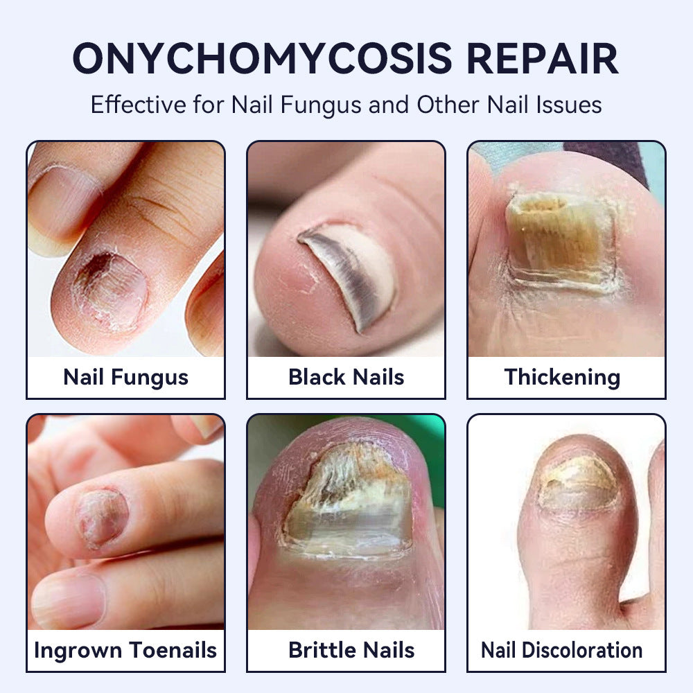 Hand And Foot Nail Thickening Bright Nail Gray Nail Antibacterial Care Solution